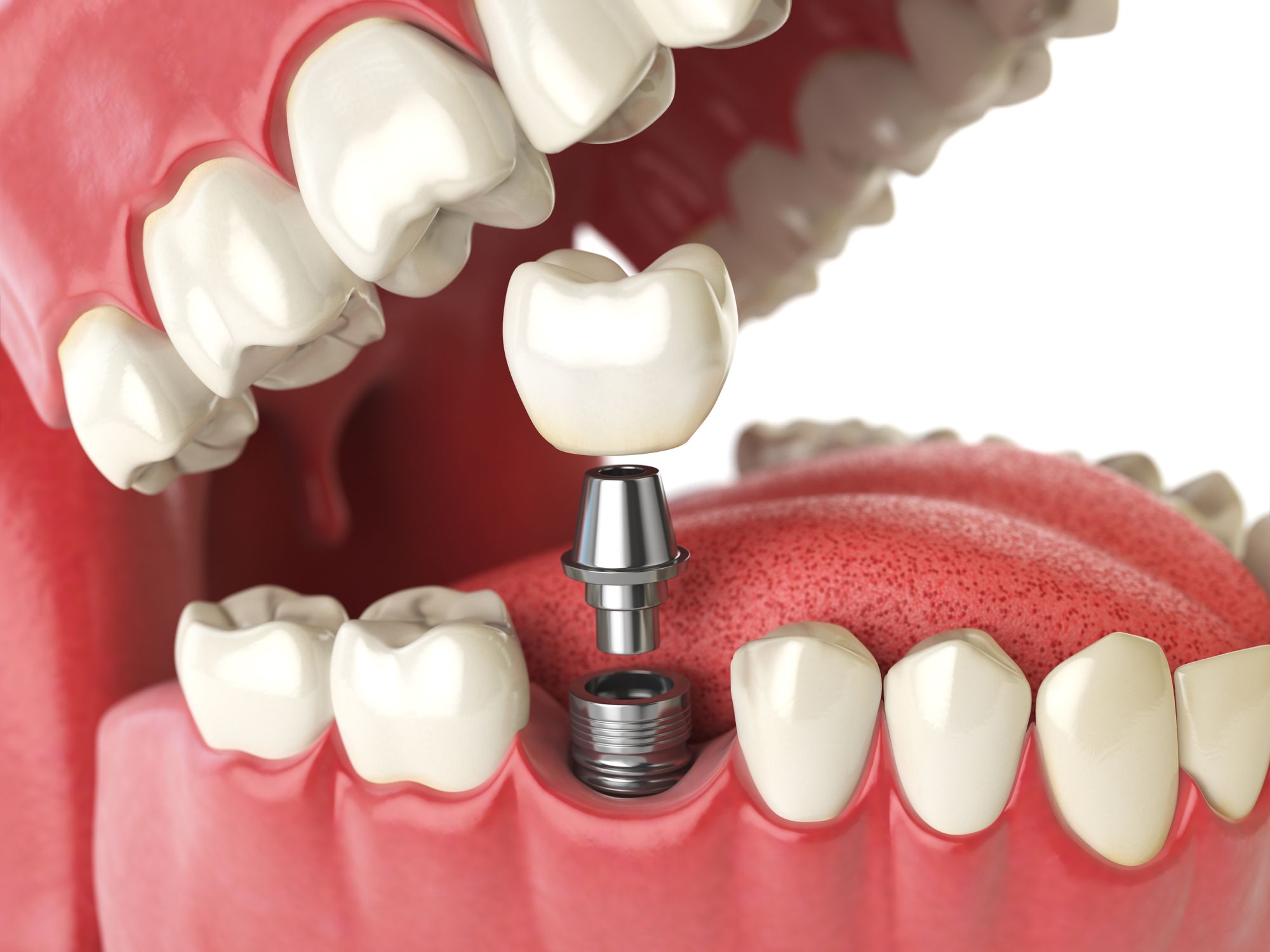 Best Dental Implant Clinic