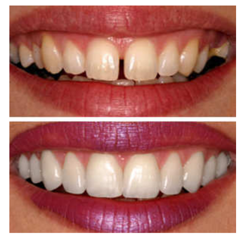 Smile Designing Treatment